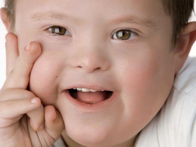 Guía médica – otorrinolaringología y síndrome de Down